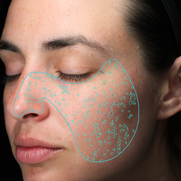 Aknenarben, California Skin, Ihre Experten für Faltenbehandlungen in München