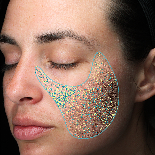 Ebenheit der Hautoberfläche, California Skin, Ihre Experten für Faltenbehandlungen in München