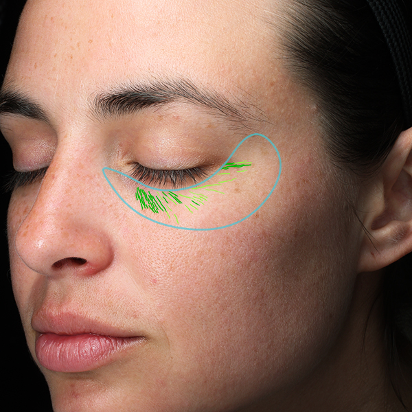 Falten & Faltentiefe, California Skin, Ihre Experten für Faltenbehandlungen in München