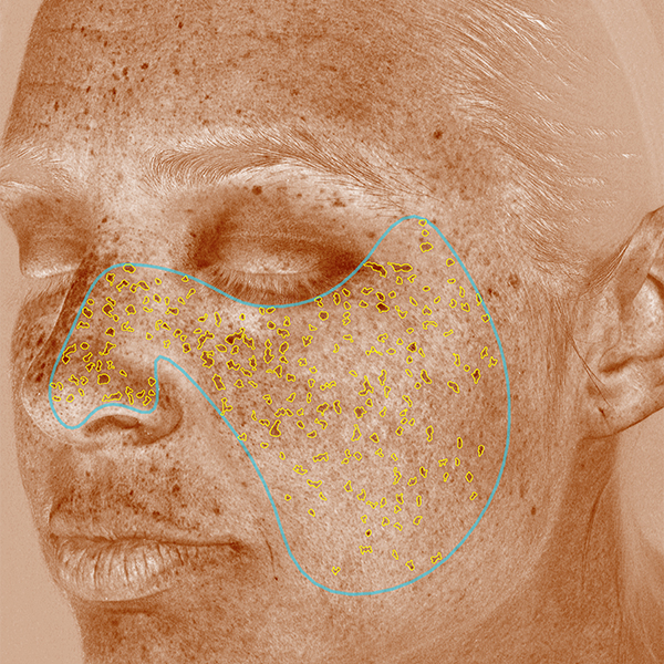 Pigmentstörungen, California Skin, Ihre Experten für Faltenbehandlungen in München