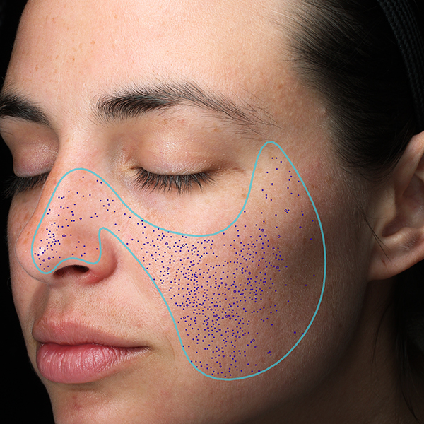 Porengröße, California Skin, Ihre Experten für Faltenbehandlungen in München