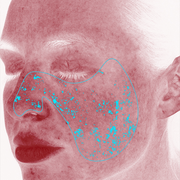 Rötungen und Entzündungen, California Skin, Ihre Experten für Faltenbehandlungen in München