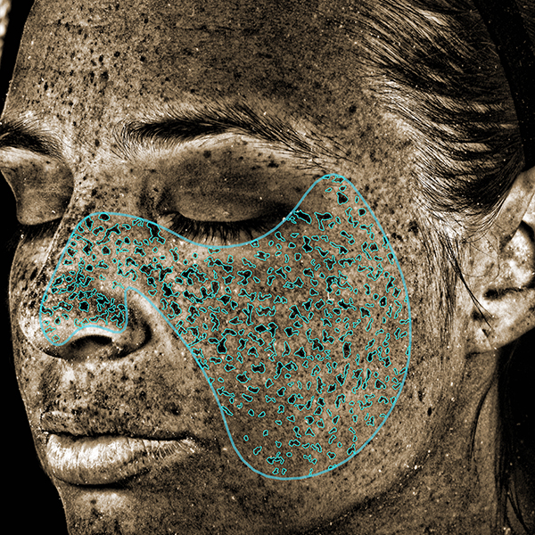 UV-Schäden, California Skin, Ihre Experten für Faltenbehandlungen in München